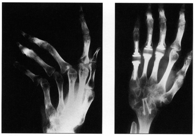 Rheumatoid Arthritis and Social Security Disability